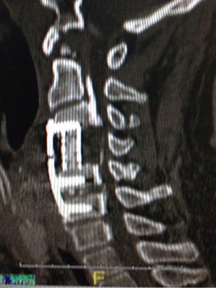 SPINE POSTOP 1a.jpg